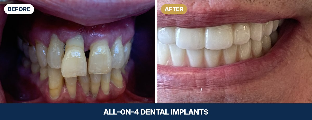 Close-up of Bobby's teeth before and after All-on-4 dental implants at New Image Dentistry in Franklin, TN