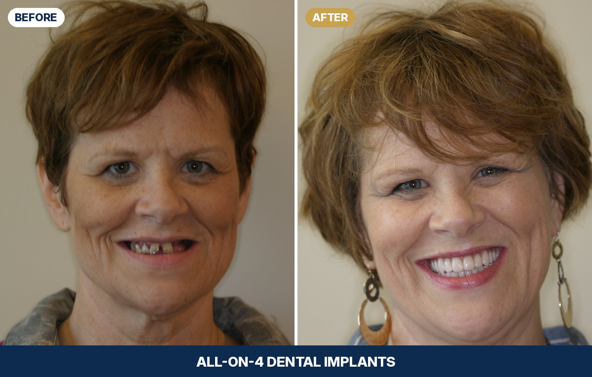Donna before and after All-on-4 dental implants at New Image Dentistry in Franklin, TN