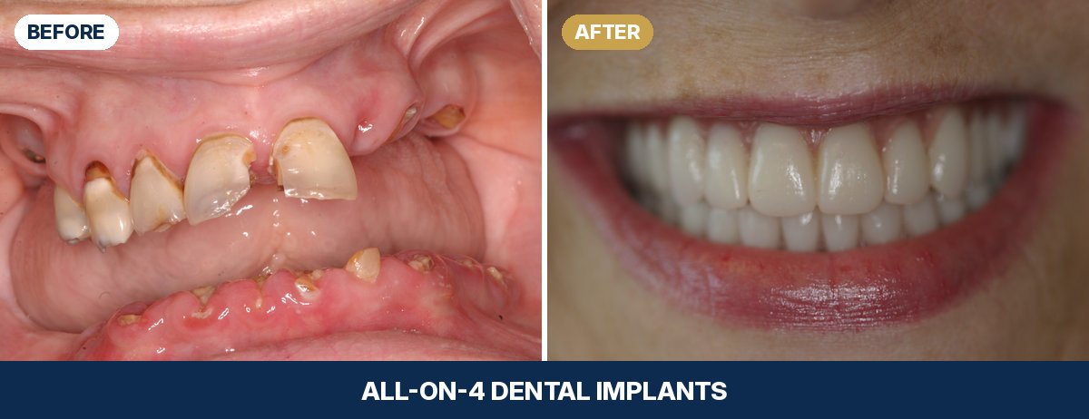 Close-up of Donna's teeth before and after All-on-4 dental implants at New Image Dentistry in Franklin, TN