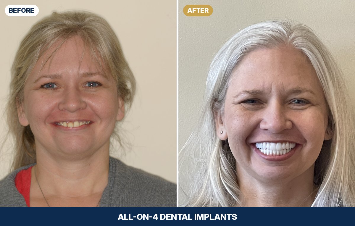 Jenn before and after All-on-4 dental implants at New Image Dentistry in Franklin, TN