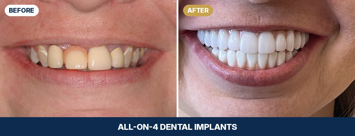 Close-up of Jenn's teeth before and after All-on-4 dental implants at New Image Dentistry in Franklin, TN